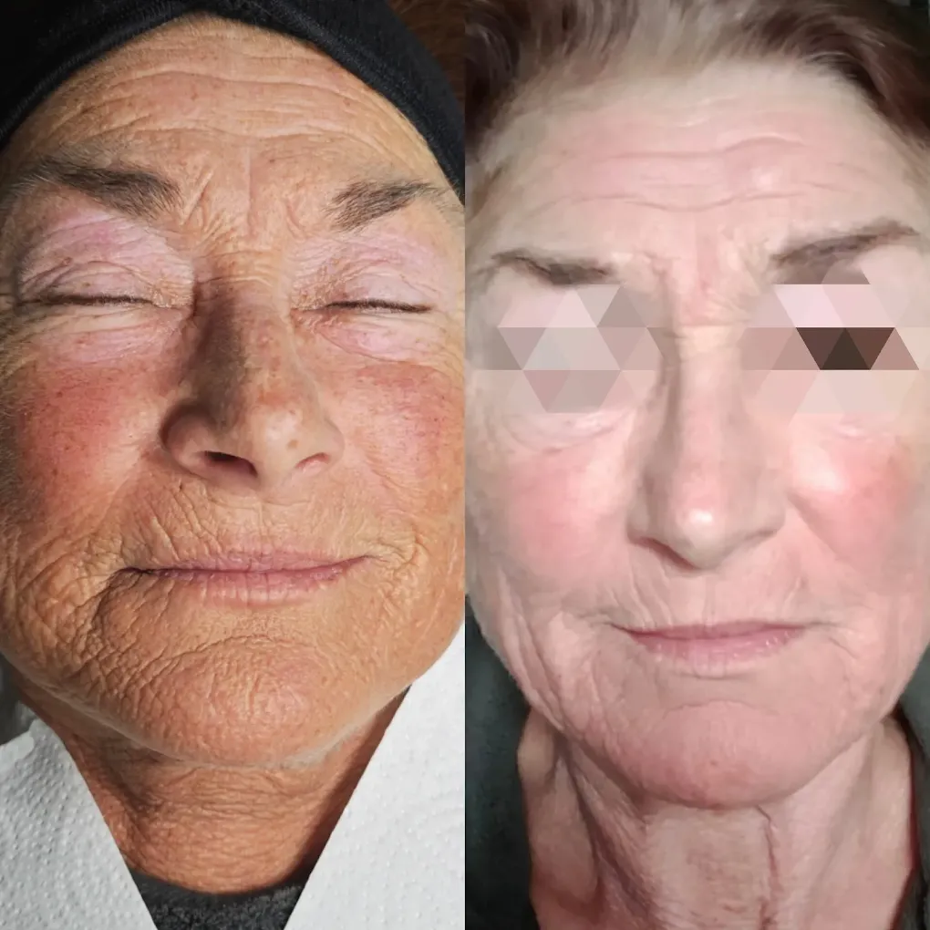 Anti-Aging Behandlung - Zaira Beauty